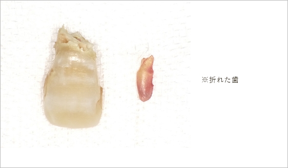セラミック治療＋インプラント治療 / 右上前歯１本 術前