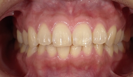 ホワイトニング 術前