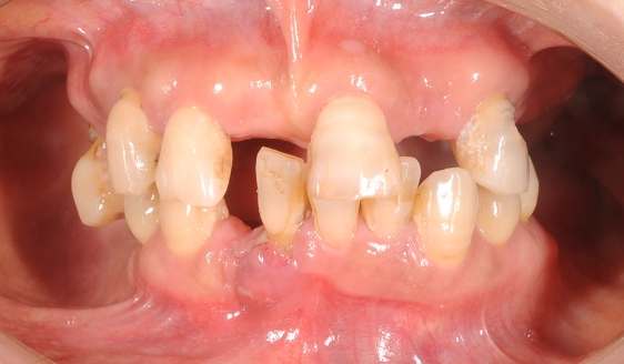全顎治療 術前